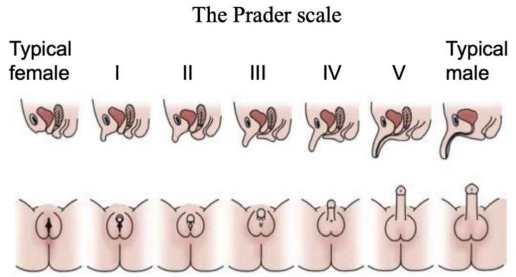 The Prader scale
